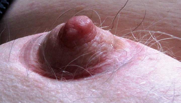 An Enlarged Nipple