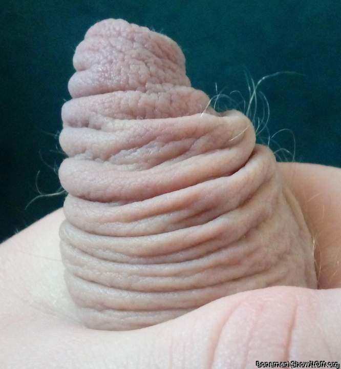 My foreskin with hairs growing from it