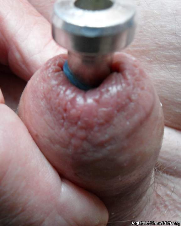 Foreskin closed with a penis plug