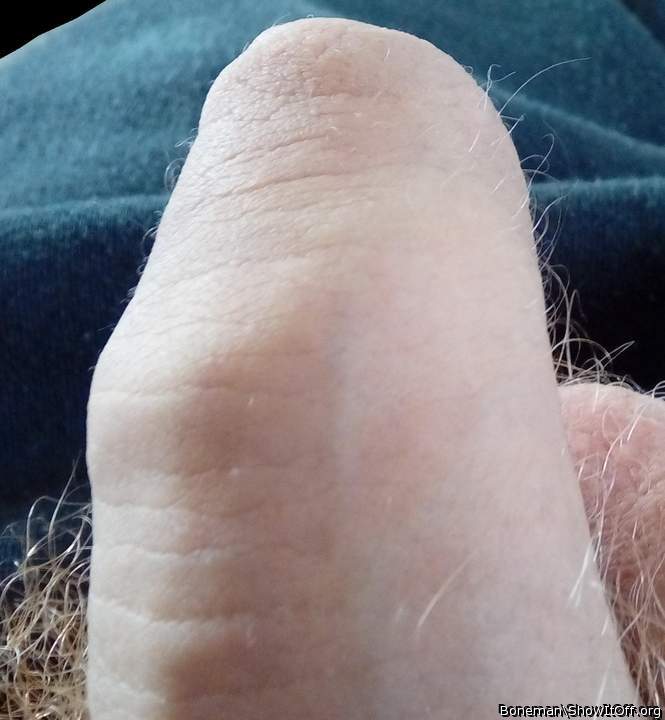 Foreskin With Hairs Growing From Sides