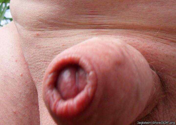 Foreskin closed from the front