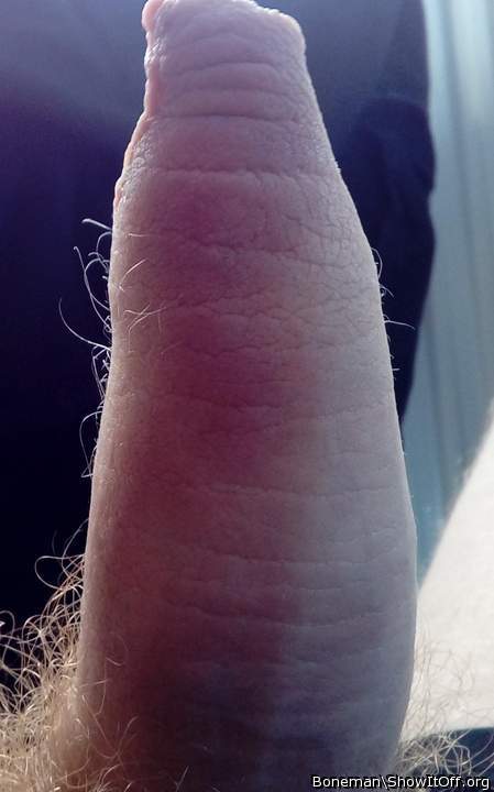 A foreskin with hair