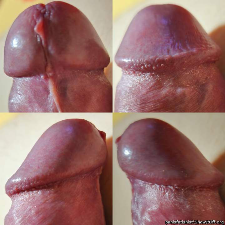 my Pearly penile papules on corona of glans penis