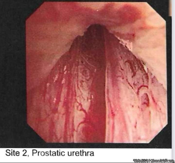 Endoscopy Internal Cock Pic 1