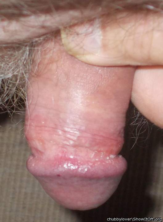 foreskin retracted