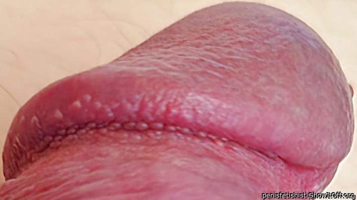 my Pearly penile papules on corona of glans penis BIG detail