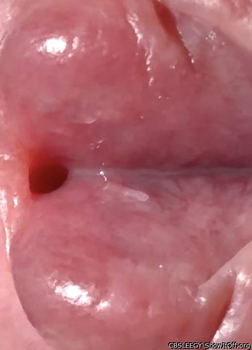 Showing uretha hole & skin tag.