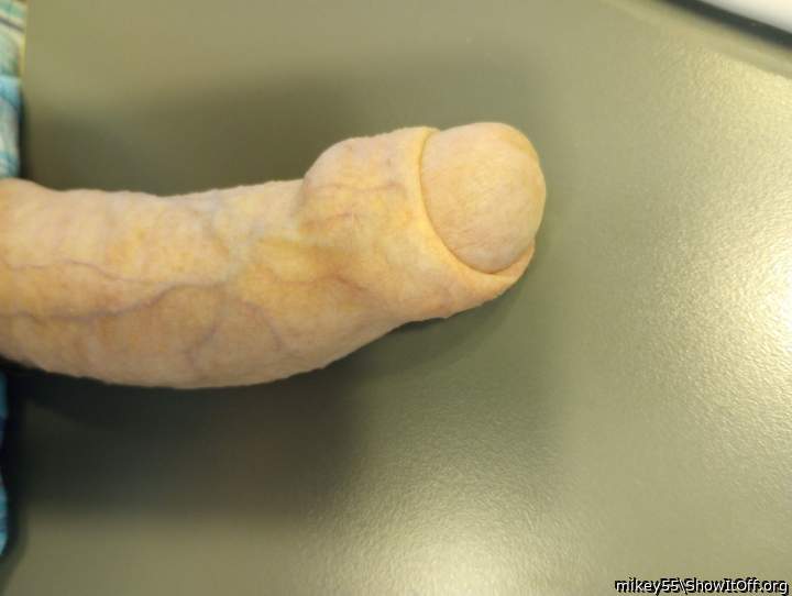 Foreskin  partially retracted.