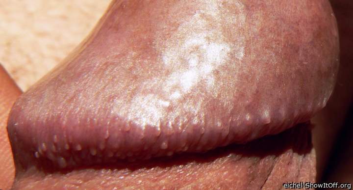 papillary hirsutism of the corona of my glans