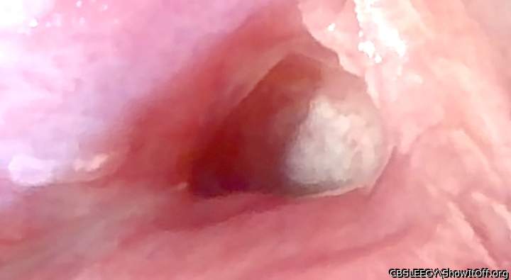 2nd Uretha Triangle Close Up with veins inside.