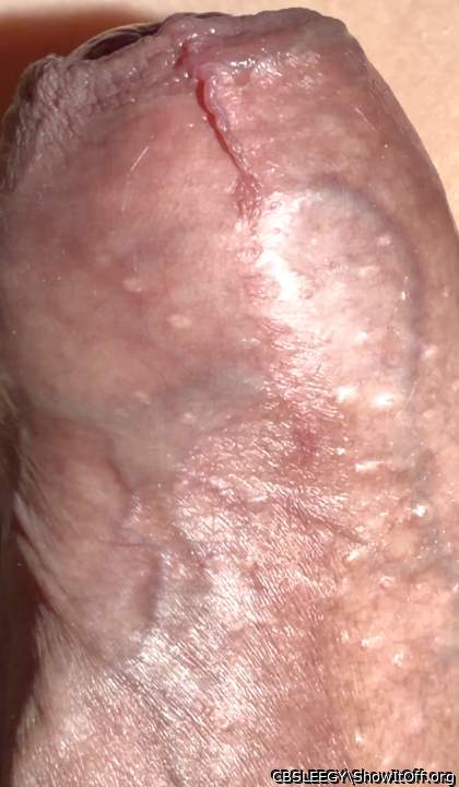 Veins in the shaft with skin forward. (See deep blue veins.)