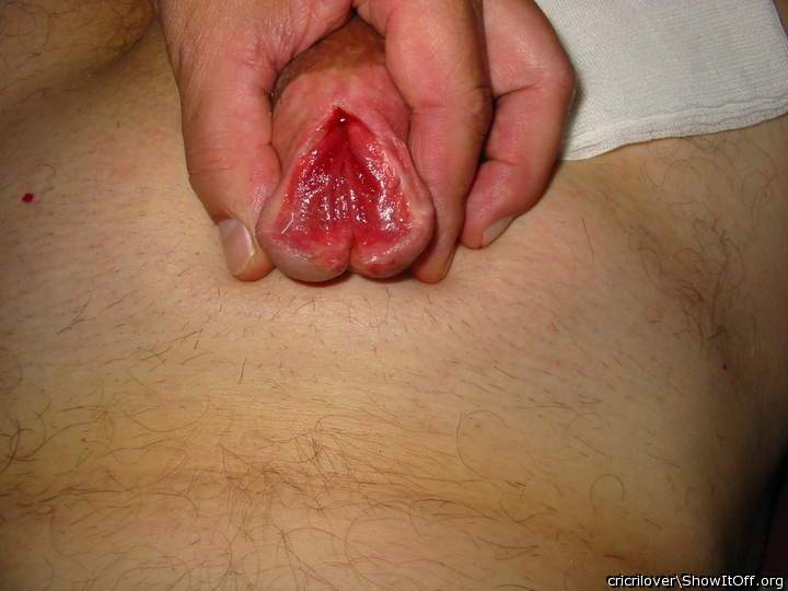 Enlargement of the subincision