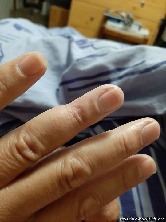 Le doigt déformé par mon trou 2