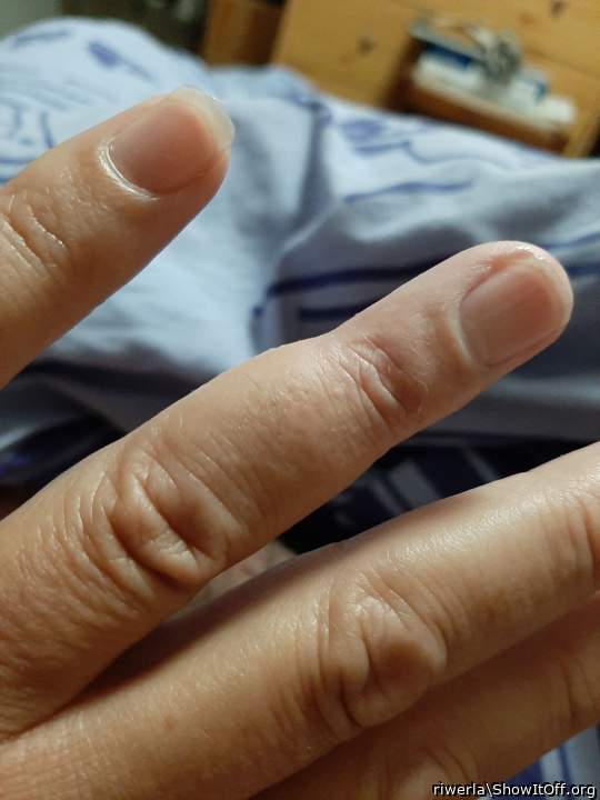 Le doigt déformé par mon trou 1