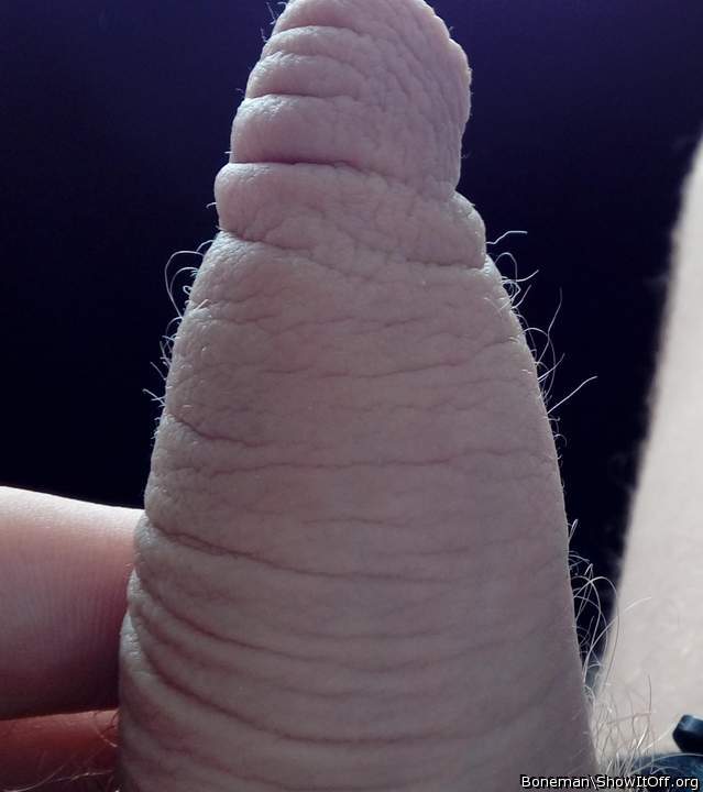 A Foreskin With Hairs Growing Up The Sides