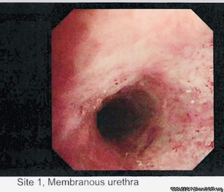 Endoscopy Internal Cock Pic 2