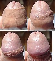 Photo of a penile from eugen